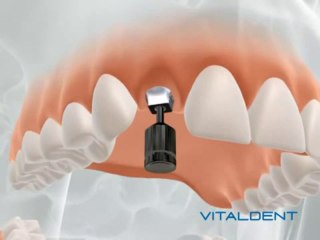 Implantes Vital Dent Barcelona