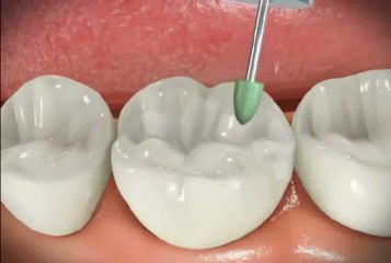 Affordable Dental Implant