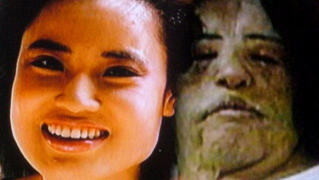 Former Model Permanently Disfigured After Plastic Surgery