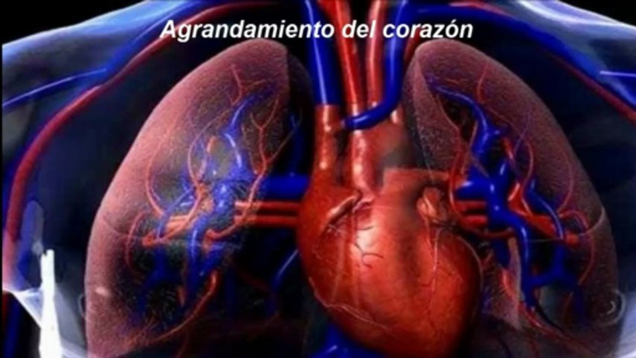 Consecuencia de Hipertension Arterial