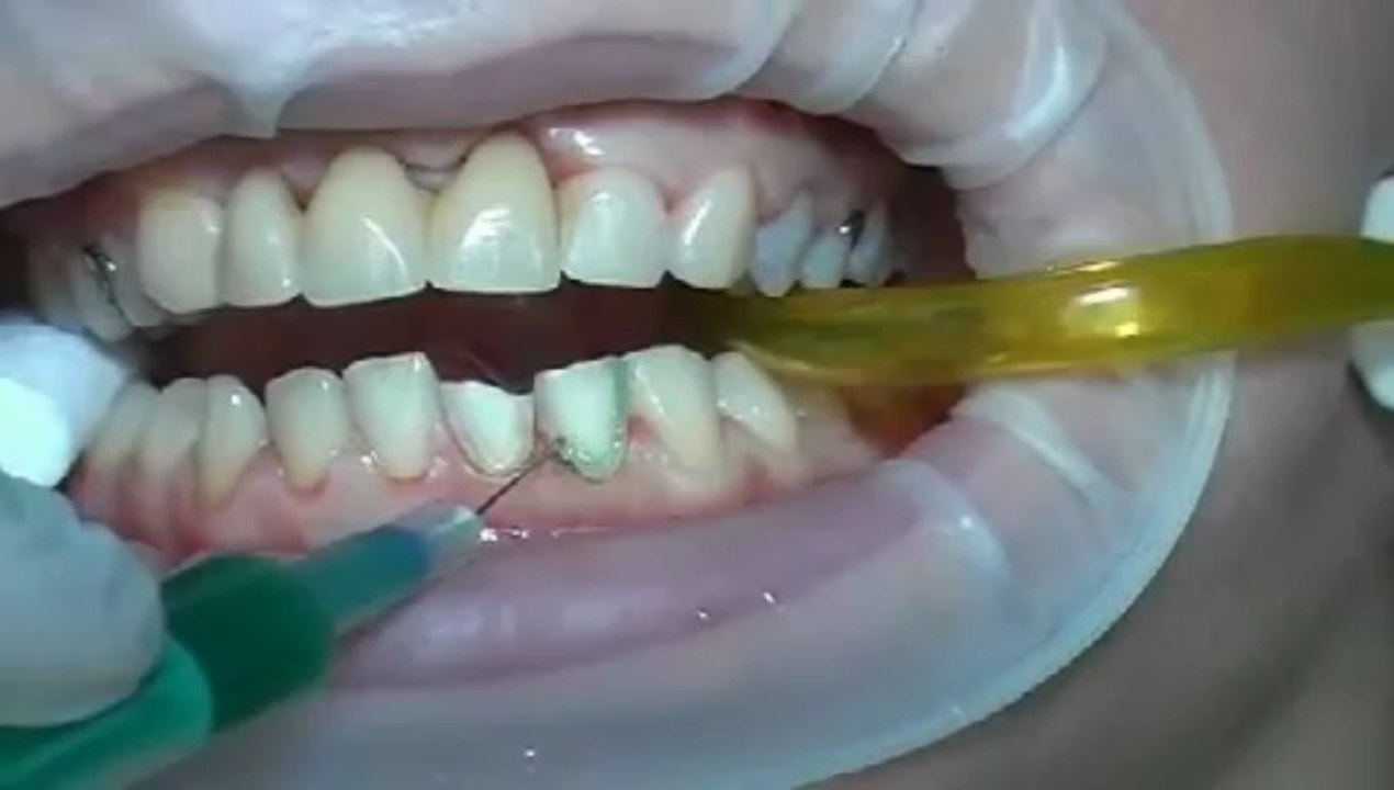 Dr Abid Faqir - What are dental veneers