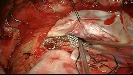 planum sphenoidale meningioma by Prof Dr Selcuk YILMAZLAR