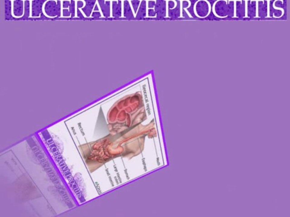 Ulcerative Proctitis