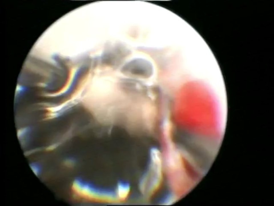 Histeroskopi ile rahim içi perde (uterin, uterus septum) kesilmesi