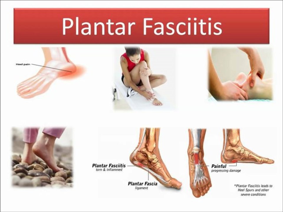 Plantar fasciitis