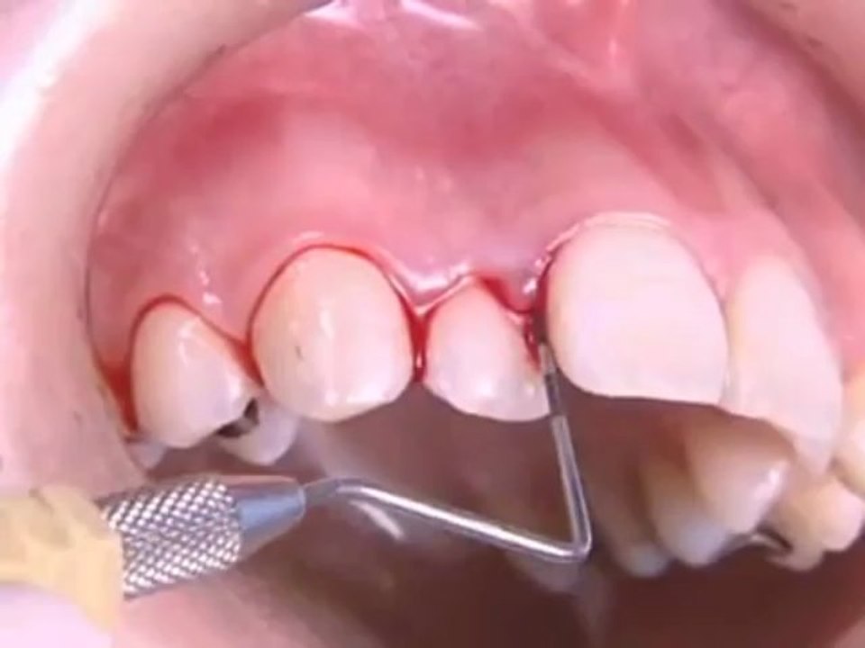 Dr Rodney Aziz - How are teeth cleaned at the dentist