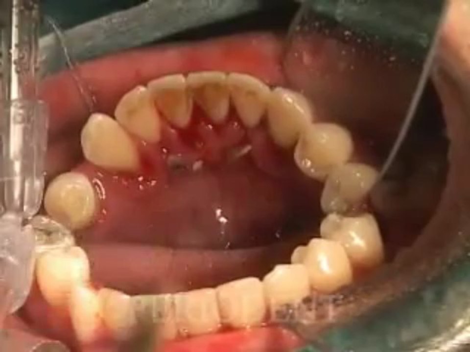 Dr Rodney Aziz - Supragingival Scaling Dental Video