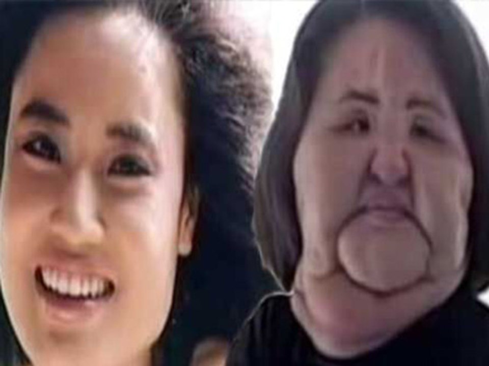 Hang Mioku Injected Cooking Oil Into Her Own Face