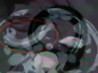 INCREIBLE!!! Tenía una lombriz gigante dentro de la barriga