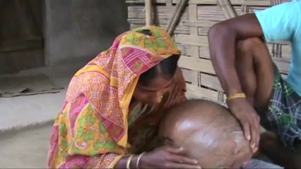 From despair to hope for Indian girl with swollen head