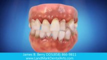 tmj dentist  San Diego ca | cosmetic dentist | best dentist