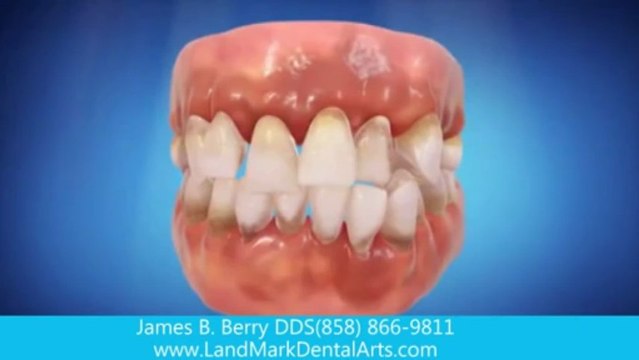 tmj dentist San Diego ca | cosmetic dentist | best dentist