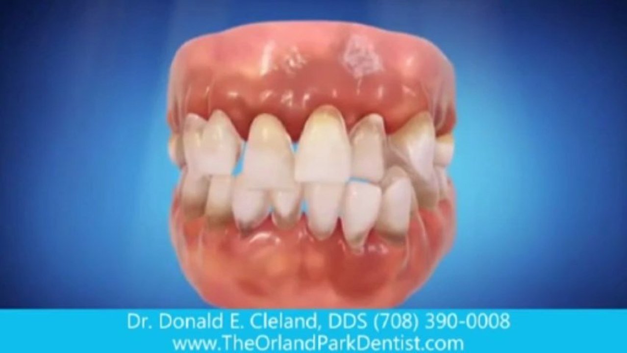 dental implant Orland Park il | implant dentist
