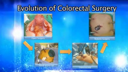 Colo Rectal Cancer - Save Medical costs in India - 100% Cure