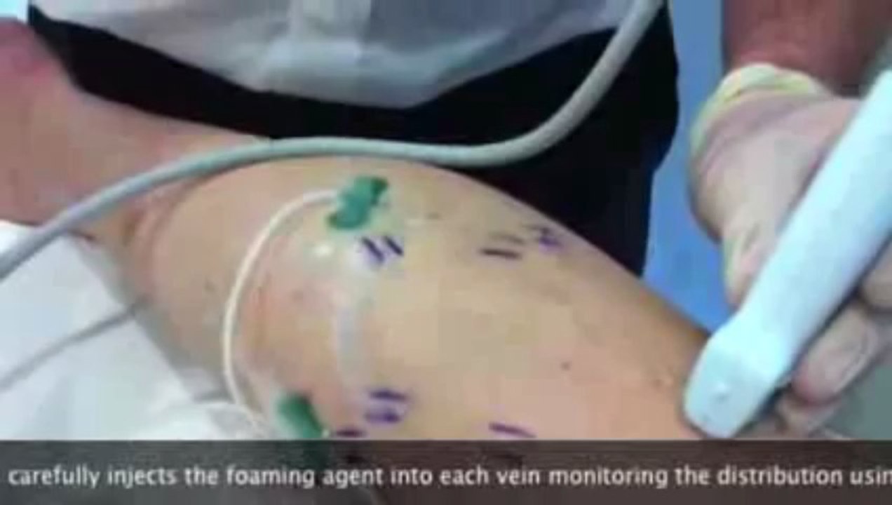 Varicose Veins treatments in UK | Sclerotherapy