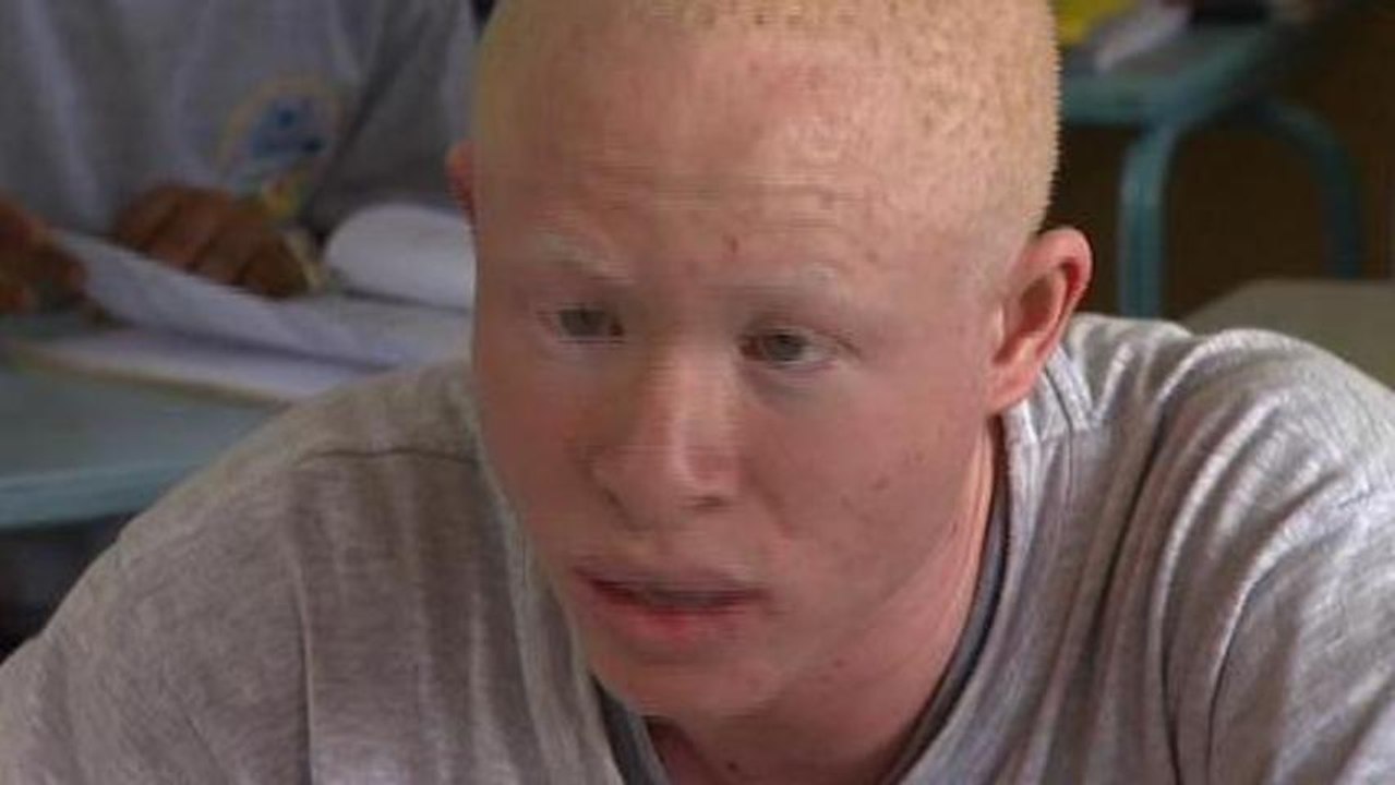 Persecuted Tanzanian albinos push for respect