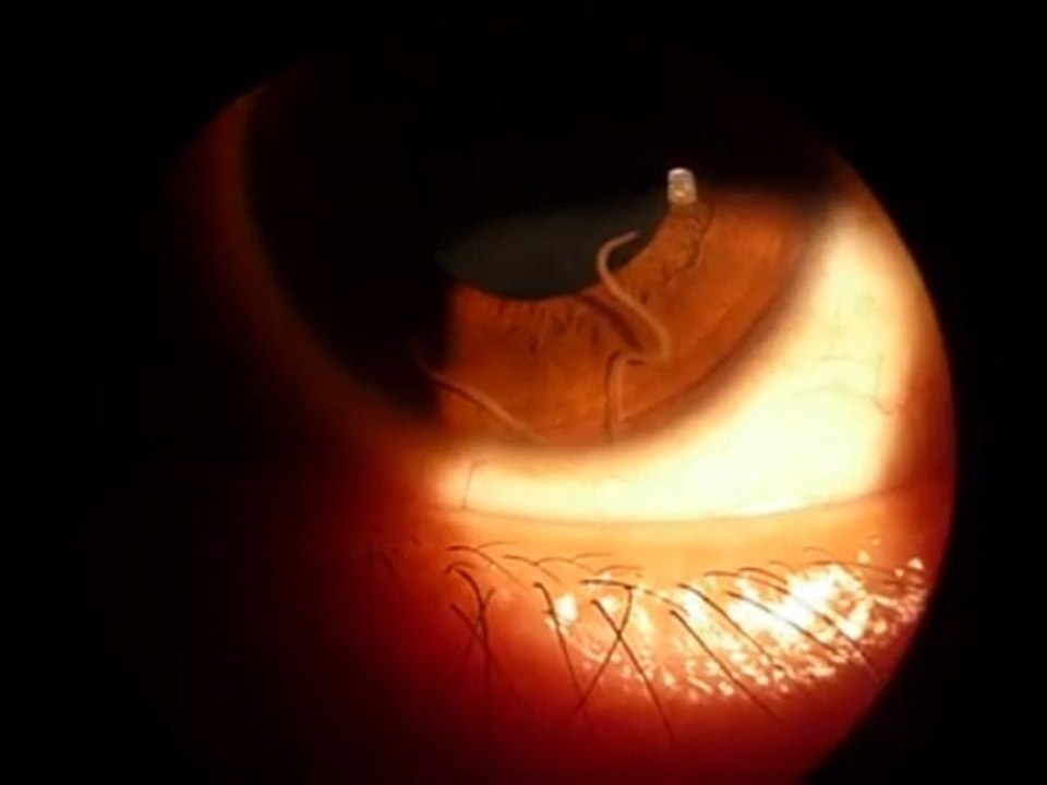 Ver parasite dans un oeil