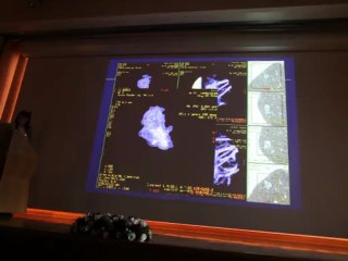 Lung Cancer Screening - Pr Marie-Pierre RFEVEL