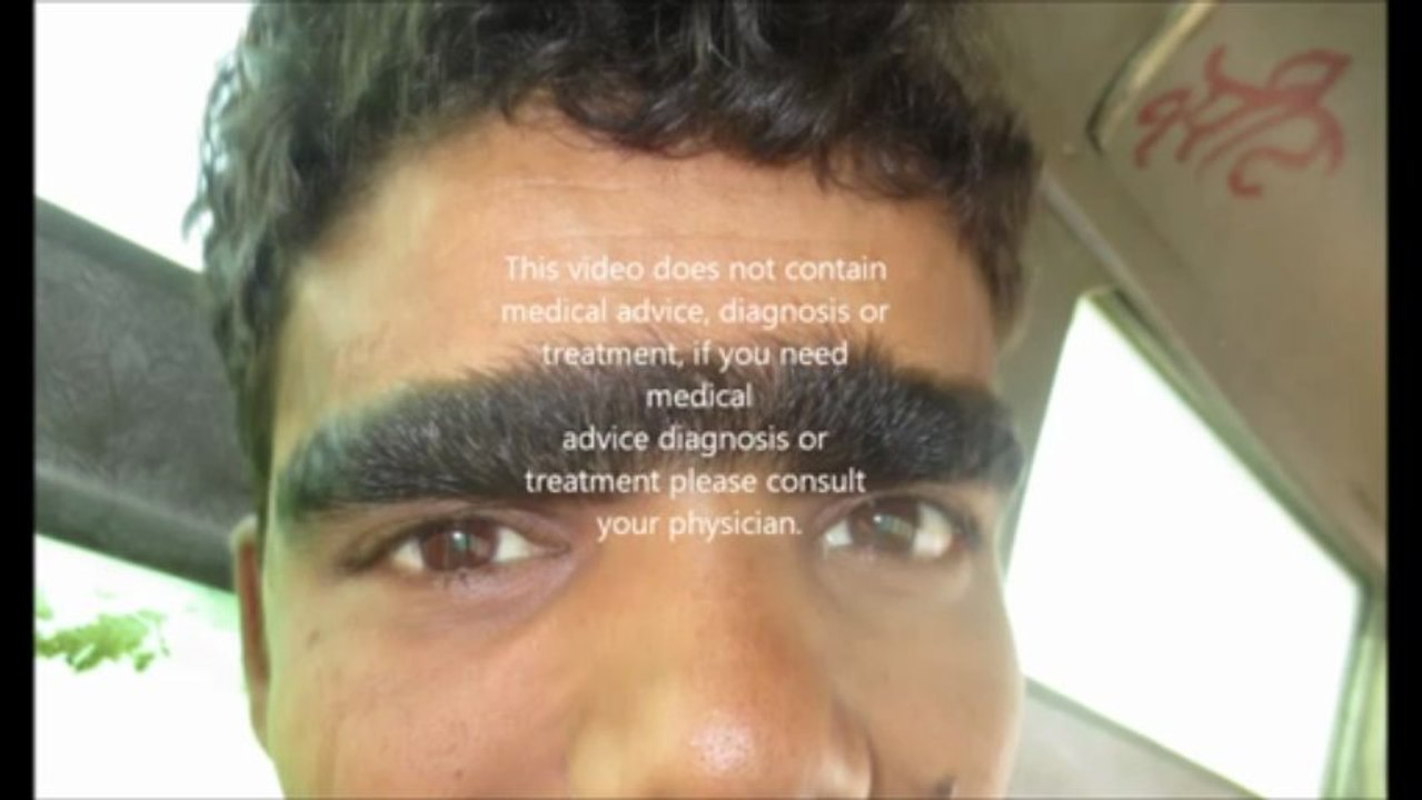 Mono-sourcil