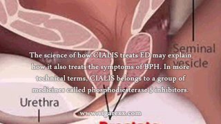 Cialis And Prostate Problems - Is Cialis Good For Benign Prostatic Hypertrophy?