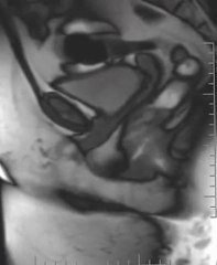 IRM d'une défécation