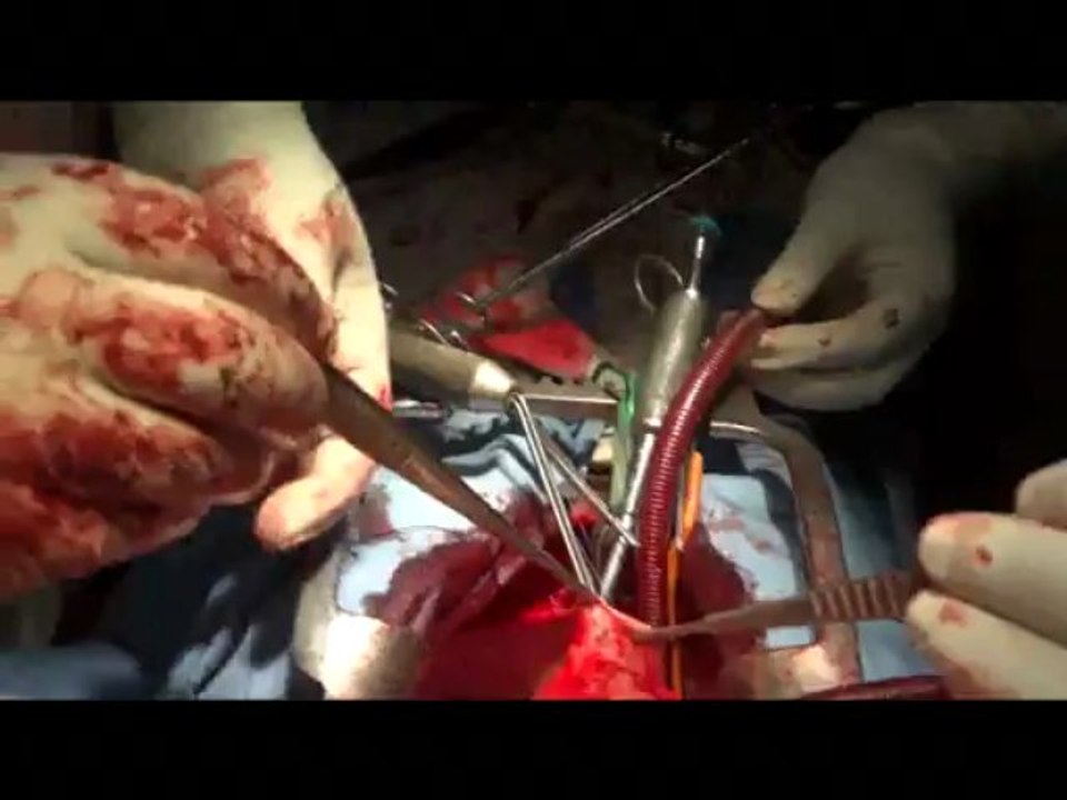 Operation of a case of Stab injury to heart [Vedio_2]