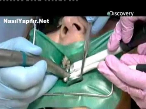 Diş Dolgusu Nasıl Yapılır? | NasılYapılır.Net |