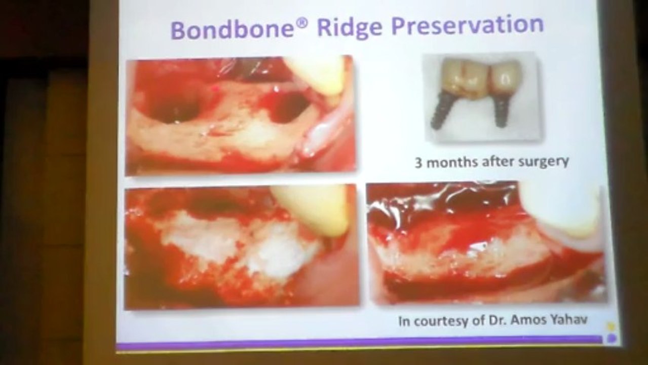 DR.DİŞHEKİMİ ERAN GABAY – 9 MAYIS 2013 - ADO EĞİTİM SEMİNERİ 3