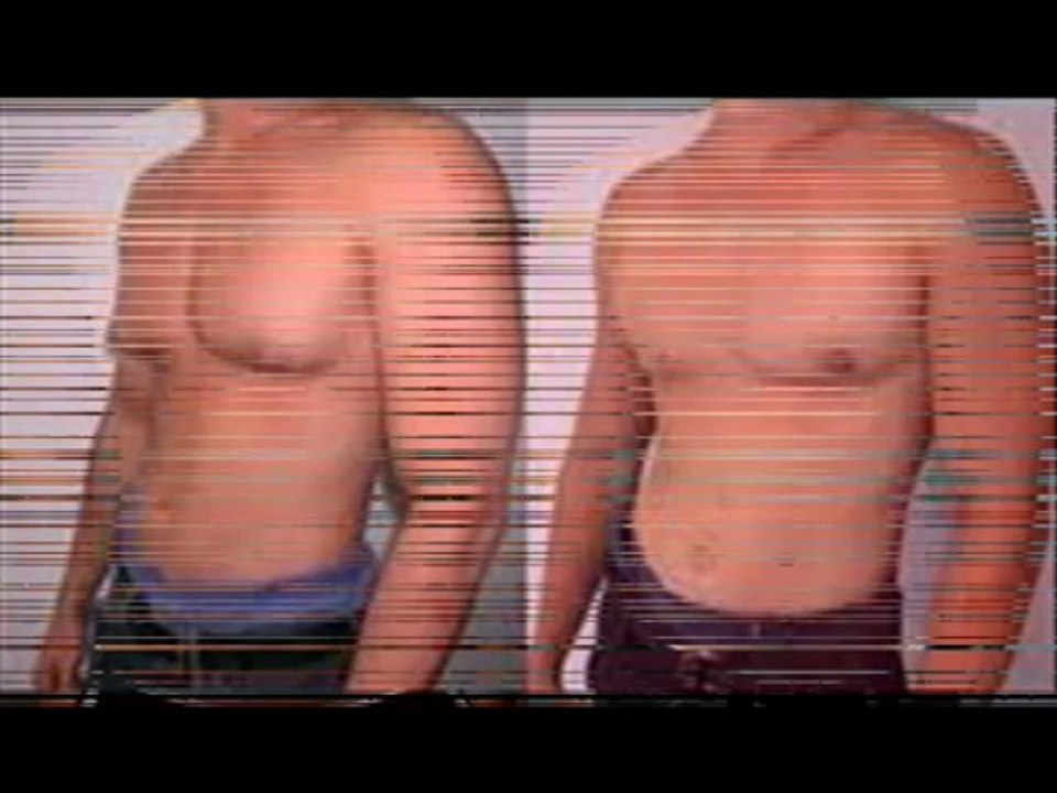 Does Gynecomastia have a Psychological Effect in Men?