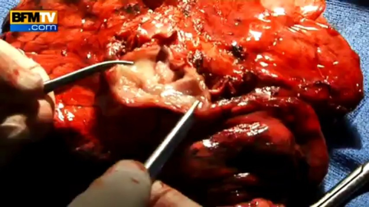 Journée mondiale sans tabac: après 30 ans de cigarette, un fumeur se fait enlever un poumon - 31/05