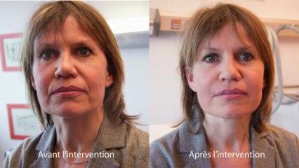 Video Acide Hyaluronique