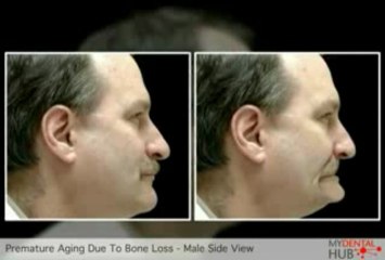Implant Dentist Chicago Describes How Premature Aging Caused By Bone Loss