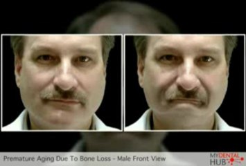 Implant Dentist In Chicago Presents How Premature Aging Caused By Bone Loss
