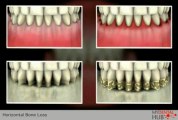 Implant Dentist Chicago Describes How Bacteria Deteriorate Jaw Bone Health