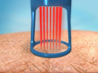 How the Pixel Perfect Fractional Laser Works.