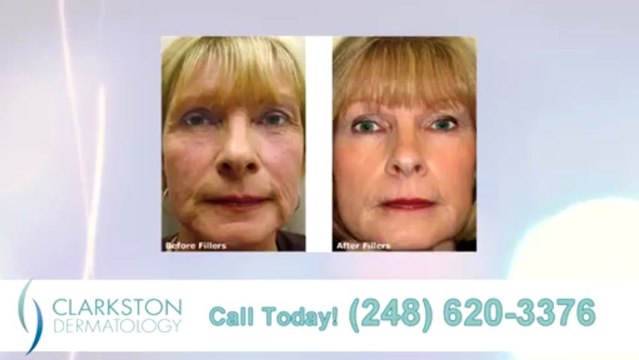 Dermal Fillers Birmingham - Clarkston Dermatology