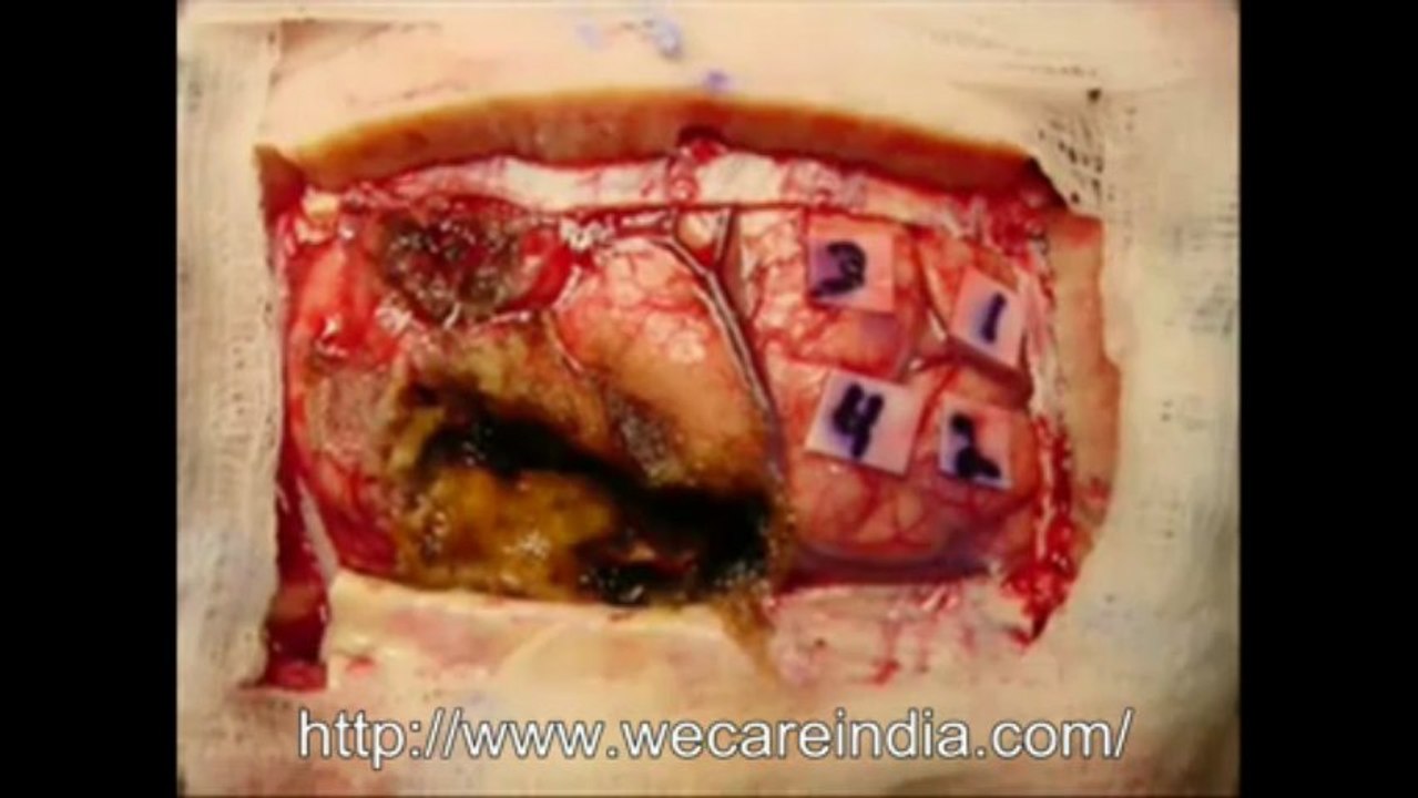 Cost of brain tumor surgery in India