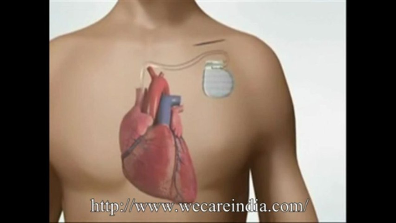 Pacemaker Treatment in India at affordable Cost - video Dailymotion