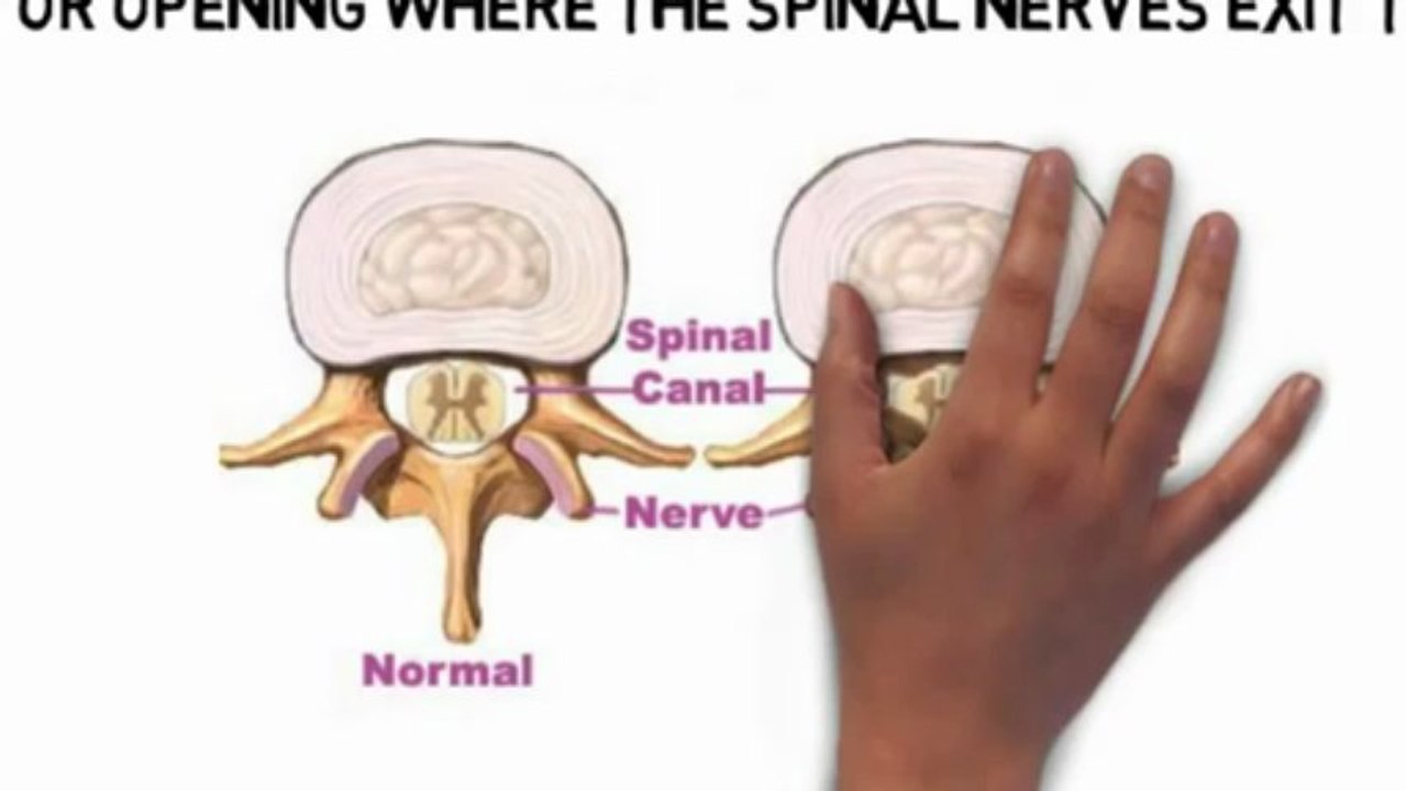 Chiropractor in Brighton MA  - Spinal Stenosis