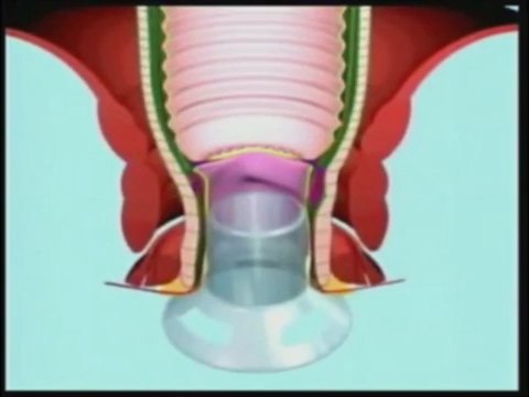 Piles Doctor Pune | Piles Hospital Pune| Piles Treatment in Pune by Healing Hands Clinic