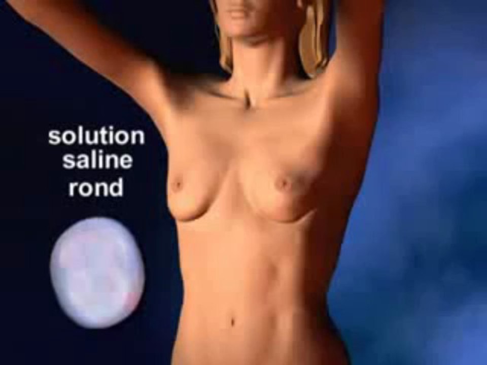 Chirurgie esthetique tunisie - Implant mammaire