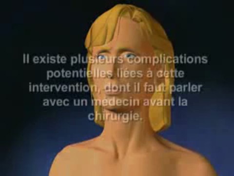 Chirurgie esthetique tunisie - Lifting visage