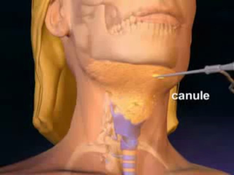 Chirurgie esthetique tunisie - liposuccion