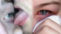 Japanese Eyeball Licking Trend Spawns Pink Eye Outbreak