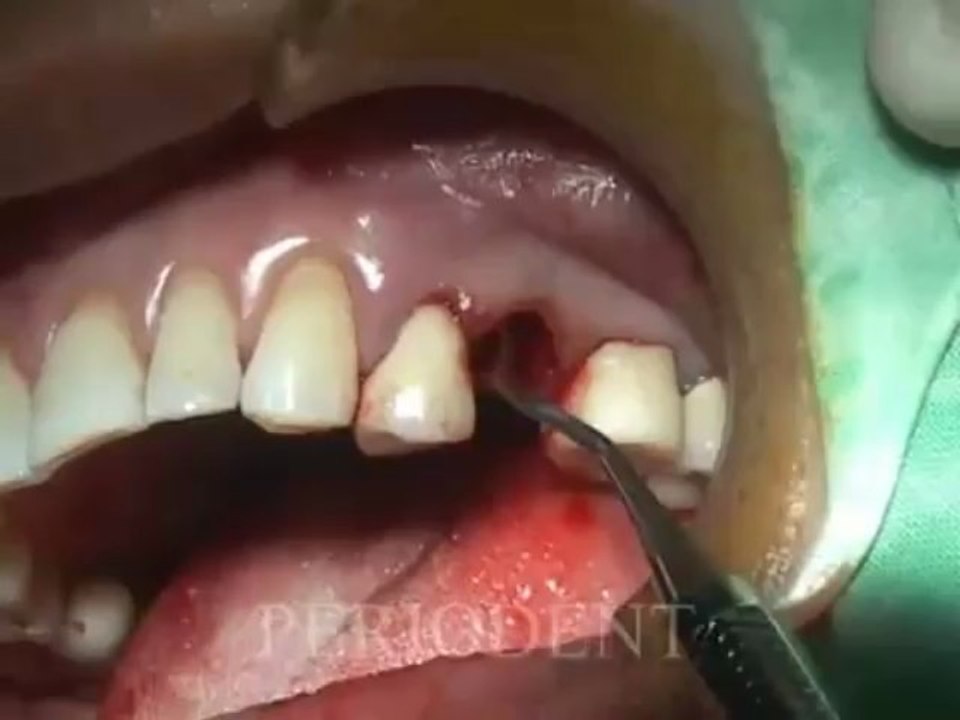 Dr Rodney Aziz -Dental Implant- Dr Rodney Aziz