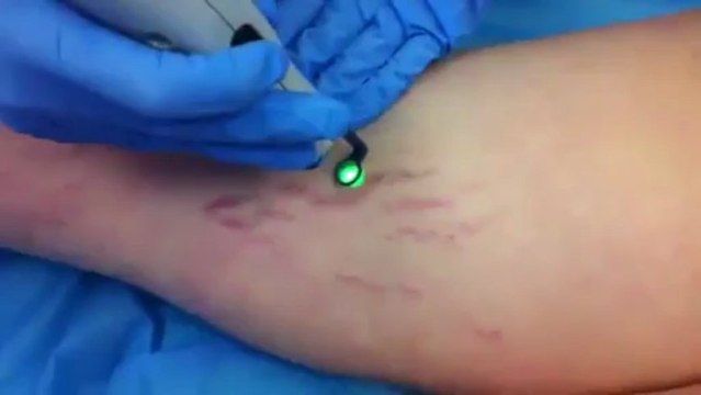 Quitar, eliminar estrias. Clinica Dermitek, Bilbao