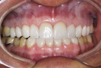 Los Angeles Veneers Specialist Dr. Rayhan