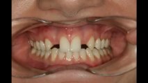 Cosmetic Dentist Sydney - Before and After - Implants, Porcelain Veneers