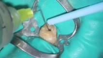 Dr Rodney Aziz - Molar Root Canal- Dr Rodney Aziz