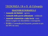 Trisomia 18 - Sindrome di Edwards